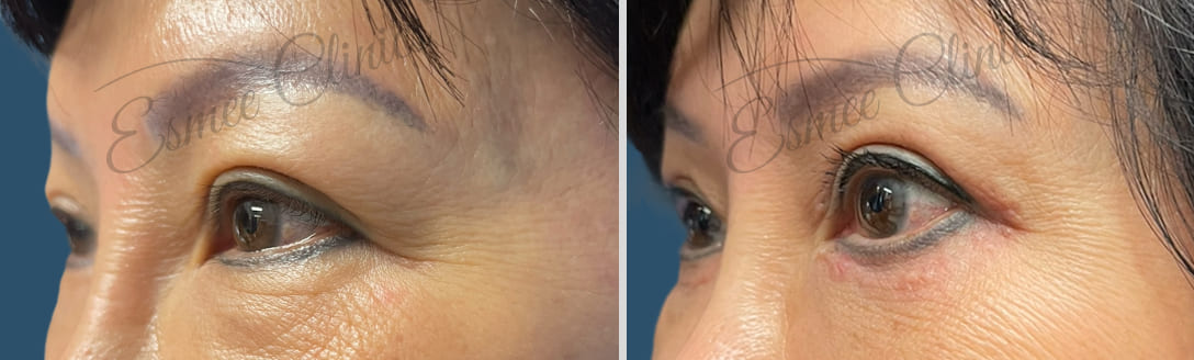 Before and After img